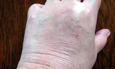 Điều trị bệnh do rối loạn thần kinh thực vật